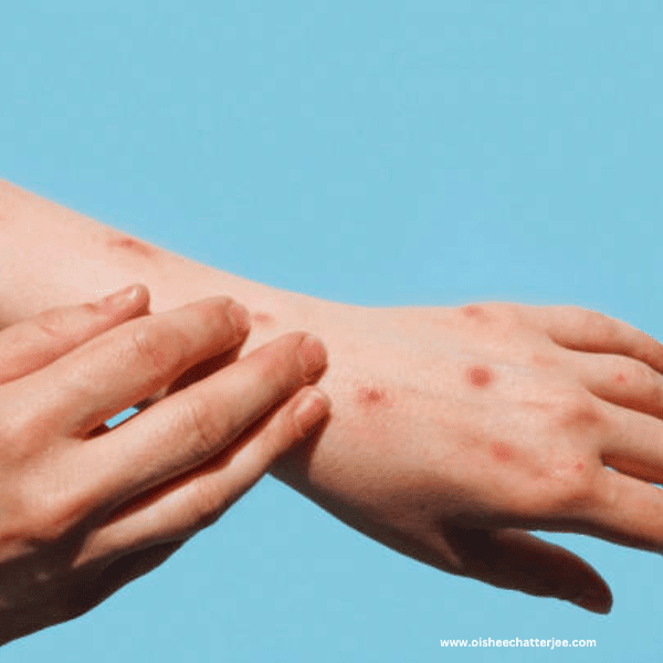 Mpox blisters 
